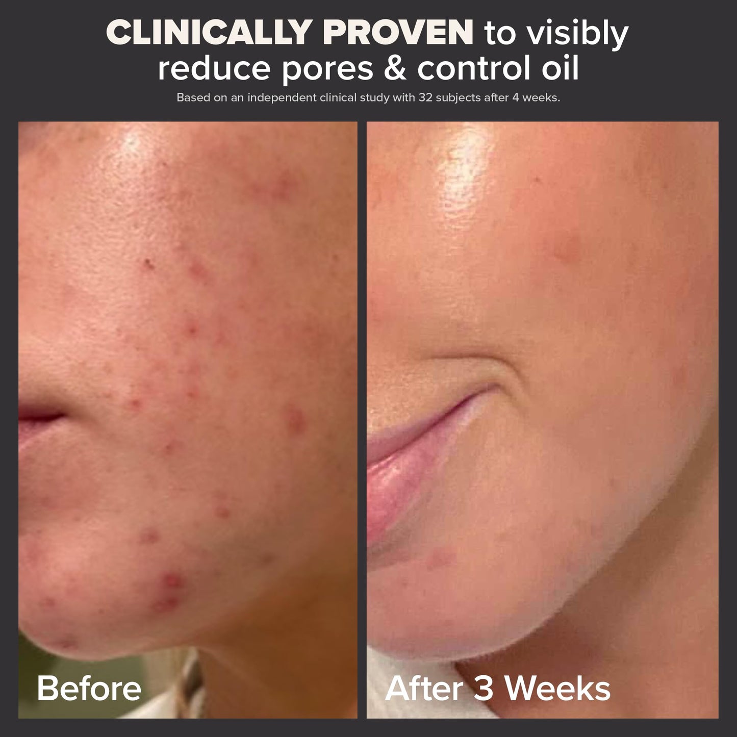 Paula's Choice Skin Perfecting 2% BHA Liquid Salicylic Acid Exfoliant Duo